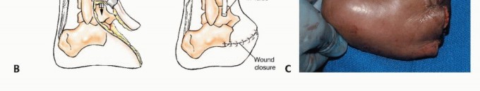 صورة طبية: أورام القدم: دليلك الشامل للعلاج، البتر، والاستئصال مع الأستاذ الدكتور محمد هطيف في صنعاء