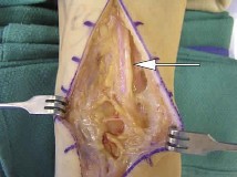 Approaches Orthopedic B Review | Dr Hutaif General Orth -...