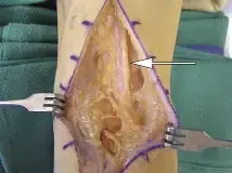 دليل شامل لجراحات العظام: المداخل الجراحية، المخاطر، والتعافي مع الأستاذ الدكتور محمد هطيف في صنعاء