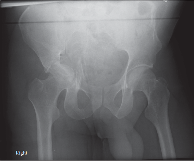 Acetabular Fractures: Epidemiology, Surgical Anatomy, Biomechanics, & Treatment Principles
