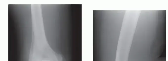 صورة توضيحية لـ تنظيف مفصل المرفق بالمنظار: الحل المتطور لآلام المرفق وتيبسه مع الدكتور محمد هطيف