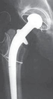 Deciding to Remove Hip Arthroplasty with Well-Fixed Components