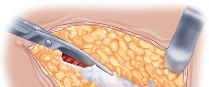 Illustration 2 for Unlock the Figure Posterior Approach to the Hip