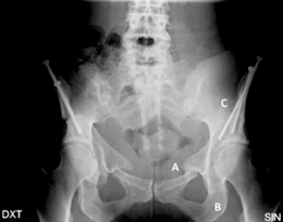 Illustration 8 for Conservative Hip Surgery: Relief for Bilateral Dysplasia
