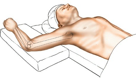 Illustration of elbow without olecranon - Dr. Mohammed Hutaif