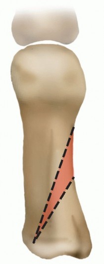 The Closing Wedge Proximal Osteotomy: A Guide to Hallux Valgus Correction