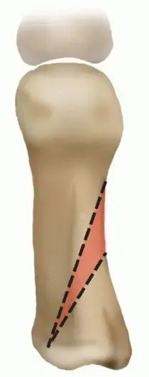 جراحة قطع العظم الإسفيني القريب (الوكعة): حل دائم لآلام إبهام القدم الأروح في اليمن والخليج العربي مع الأستاذ الدكتور محمد هطيف