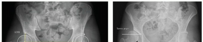 Illustration 5 for Periacetabular Osteotomy: Realigning your hip via the superior pubic ramus