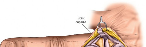 Illustration 169 for Essential Surgical Approaches: Uncover Every Aspect of the Wrist