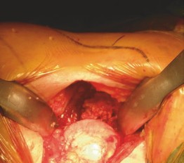 Illustration 6 for Mastering Direct Anterior Approach Hip Arthroplasty Without a Traction Table