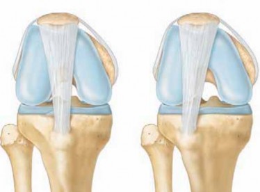 Tibial Tubercle Transfer: Permanent Relief When Patella Enters the Trochlea