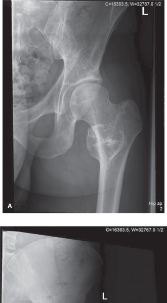 Chondrosarcoma Oncology Cases: Diagnostic Insights & Challenges