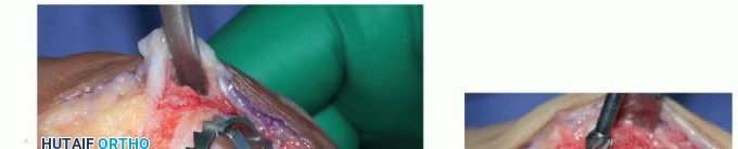 Illustration 7 for MTP Joint Arthrodesis: The Key to Optimal Toe Positioning