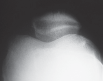 Illustration 6 for Knee Arthroplasty: Avoiding Pitfalls & Benefiting from UKA