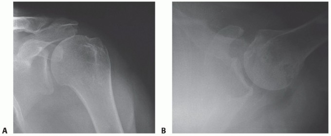 Illustration 6 for Restore Shoulder Function with Latissimus Dorsi Tendon Transfer