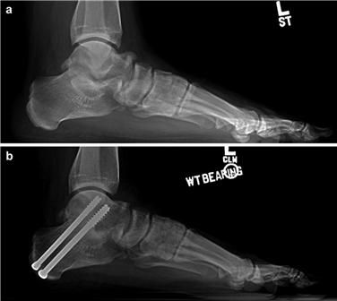 Illustration 52 for First Metatarsal Surgery: Expert Solutions for Foot & Ankle Pain