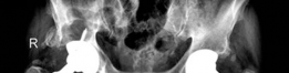 Revision THA Acetabulum: Overcoming Paprosky IIIA & Metallosis