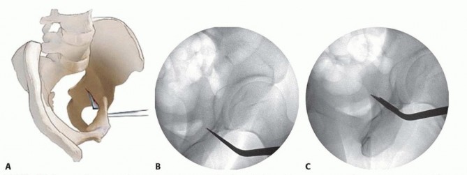 Illustration 14 for Restore Hip Health: Pelvic Osteotomy for Acetabular Dysplasia & CEA of Less