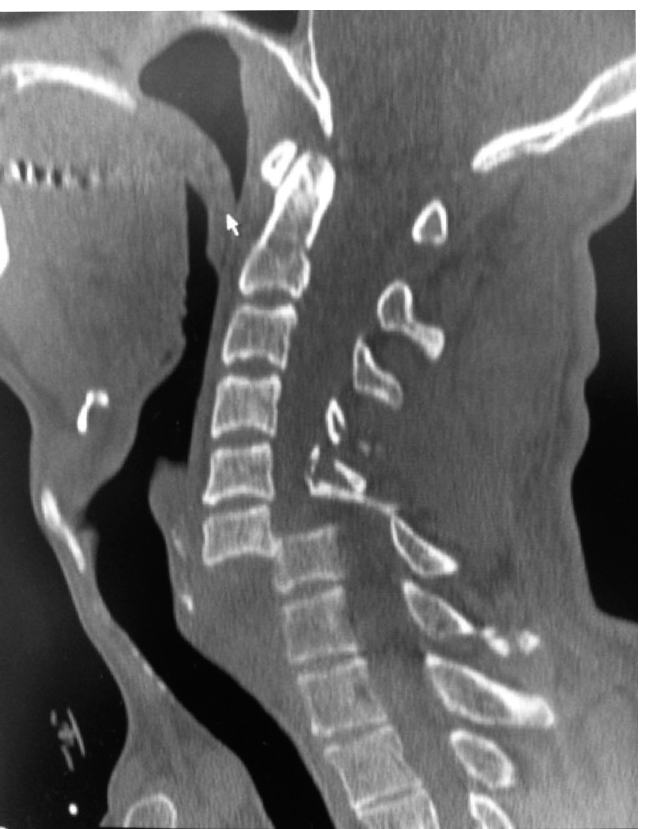 Bilateral Cervical Facet Dislocation: Expert Management