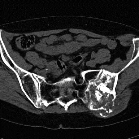 Chondrosarcoma Orthopaedic Examination Question: Ace Your Test