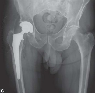 صورة أشعة سينية بعد الجراحة تُظهر إزالة الغرسة والتحويل إلى
![صورة طبية: جراحة استبدال مفصل الورك في كسور الفخذ القريبة: دليل شامل للمرضى مع الأستاذ الدكتور محمد هطيف