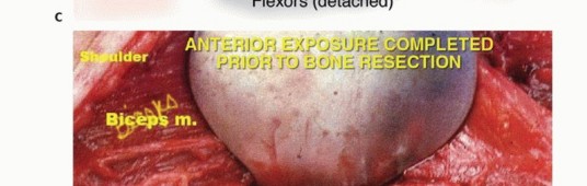 صورة طبية: استئصال الجزء البعيد من عظم العضد: تقنيات آمنة للحفاظ على الطرف في صنعاء مع الأستاذ الدكتور محمد هطيف