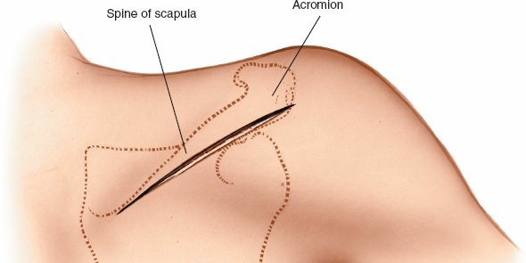 Illustration 159 for Essential Guide: Mastering Every Approach to the Shoulder