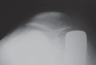 Illustration 63 for Unicompartmental Knee Arthroplasty: Master decisions with this b c figure guide.