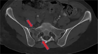 صورة توضيحية لـ كسور العجز: دليلك الشامل لإدارة متقدمة وعلاج على يد الأستاذ الدكتور محمد هطيف في صنعاء