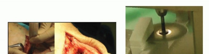 Illustration 19 for High Tibial Osteotomy: Realignment for Lasting Knee Pain Relief