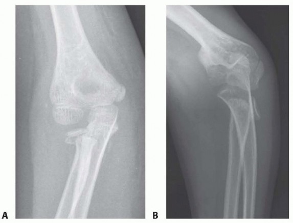 Closed, Percutaneous, Intramedullary, and Open Reduction of Radial Head and Neck Fractures