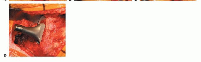 Illustration 23 for Uncemented THA: Critical Soft Tissue Tension for Joint Stability