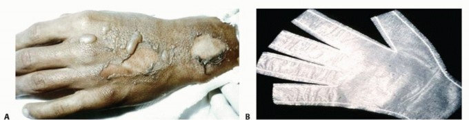 Skin Grafts and Skin Graft Substitutes in the Distal Upper Extremity
