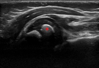Illustration 2 for Diagnosing Brachial Plexus Birth: Newborn Arm Paralysis Case