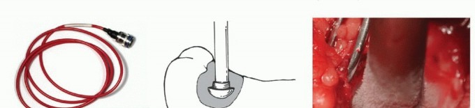 صورة طبية: تجنب الجراحة الكبرى: علاج أورام العظام بالنيتروجين السائل بتقنية الصب المباشر