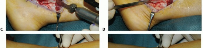 Illustration 21 for Beyond Primary Repair: Solutions for Peroneal Tendon Subluxation