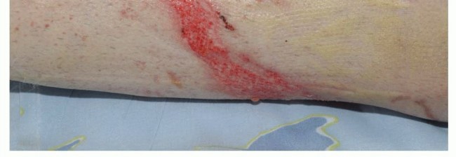 صورة طبية: تجنب الجراحة الكبرى: علاج أورام العظام بالنيتروجين السائل بتقنية الصب المباشر