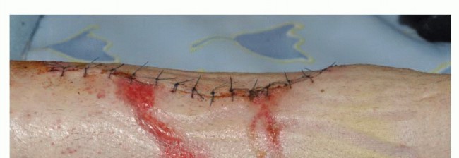 صورة طبية: تجنب الجراحة الكبرى: علاج أورام العظام بالنيتروجين السائل بتقنية الصب المباشر