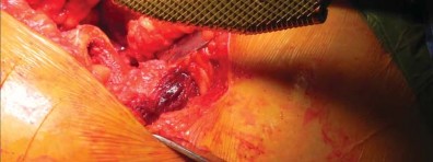 صورة طبية: تقنية الجذع القصير لاستبدال مفصل الورك الكلي: نهج الأستاذ الدكتور محمد هطيف لتدخل جراحي أقل ونتائج أفضل