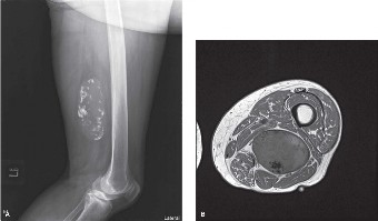 Solving Liposarcoma: Critical Oncology Cases & Diagnosis Insights