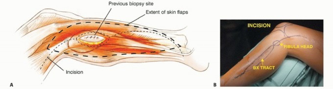 صورة أشعة سينية لورم في الشظية