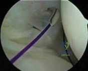 Orthopedic Oncology cases Medical myeloma treatment and prognosis