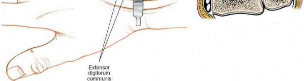 Illustration 24 for Essential Surgical Approaches: Uncover Every Aspect of the Wrist