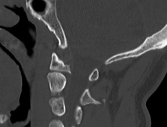 Illustration 4 for Spine Cases: Consider the Patient for Accurate Diagnosis