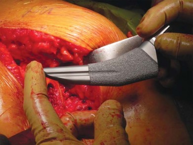 صورة طبية: تقنية الجذع القصير لاستبدال مفصل الورك الكلي: نهج الأستاذ الدكتور محمد هطيف لتدخل جراحي أقل ونتائج أفضل