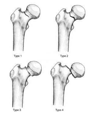 Femur Neck Fracture: Causes, Symptoms, Diagnosis, Treatment, and More