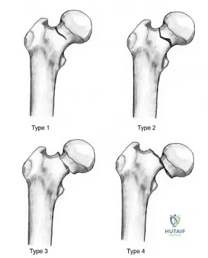 Femur Neck Fracture: Causes, Symptoms, Diagnosis, Treatment, and More