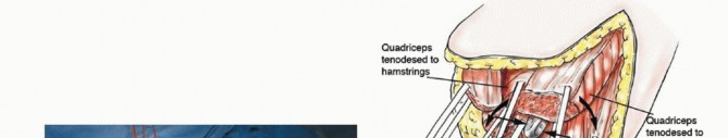 صورة طبية: استئصال مفصل الورك: دليل شامل للمرضى مع الأستاذ الدكتور محمد هطيف