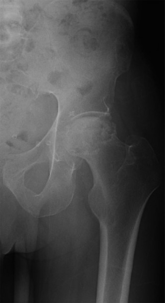 Avascular Necrosis: Navigating Complex Reconstruction Cases