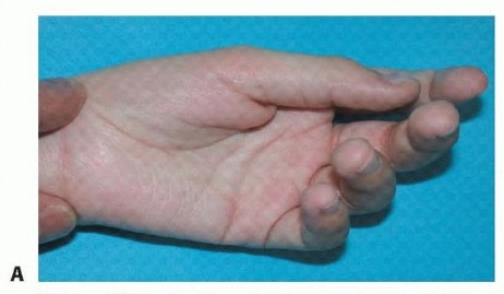 Regain Hand Function: Correcting Thumb-in-Palm Deformity in Cerebral Palsy